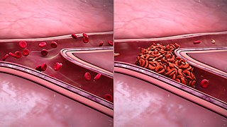 <span class="mw-page-title-main">Sickle cell nephropathy</span> Medical condition