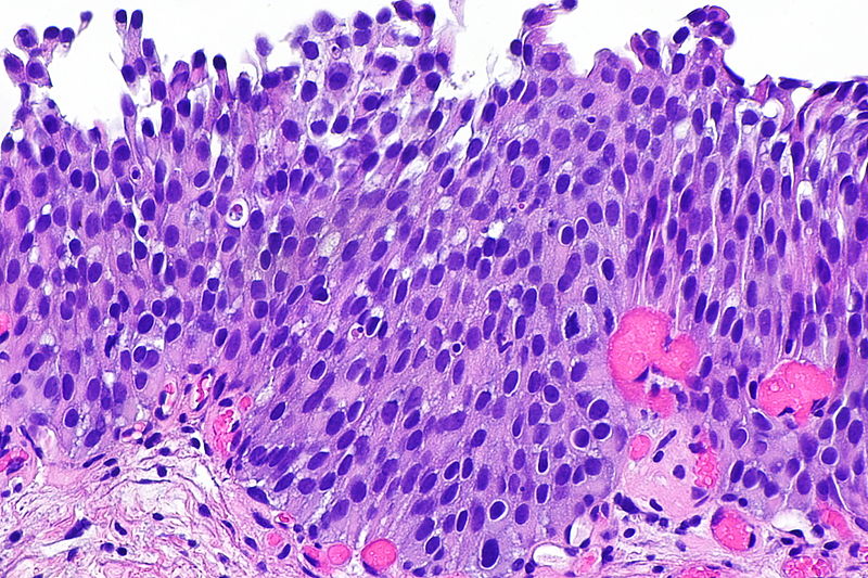 File:Urothelial dysplasia -- high mag.jpg