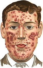 An introduction to dermatology (1905) Acne (indurta).jpg