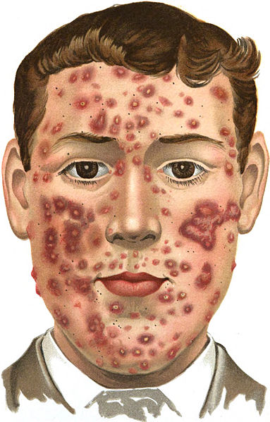 File:An introduction to dermatology (1905) Acne (indurta).jpg