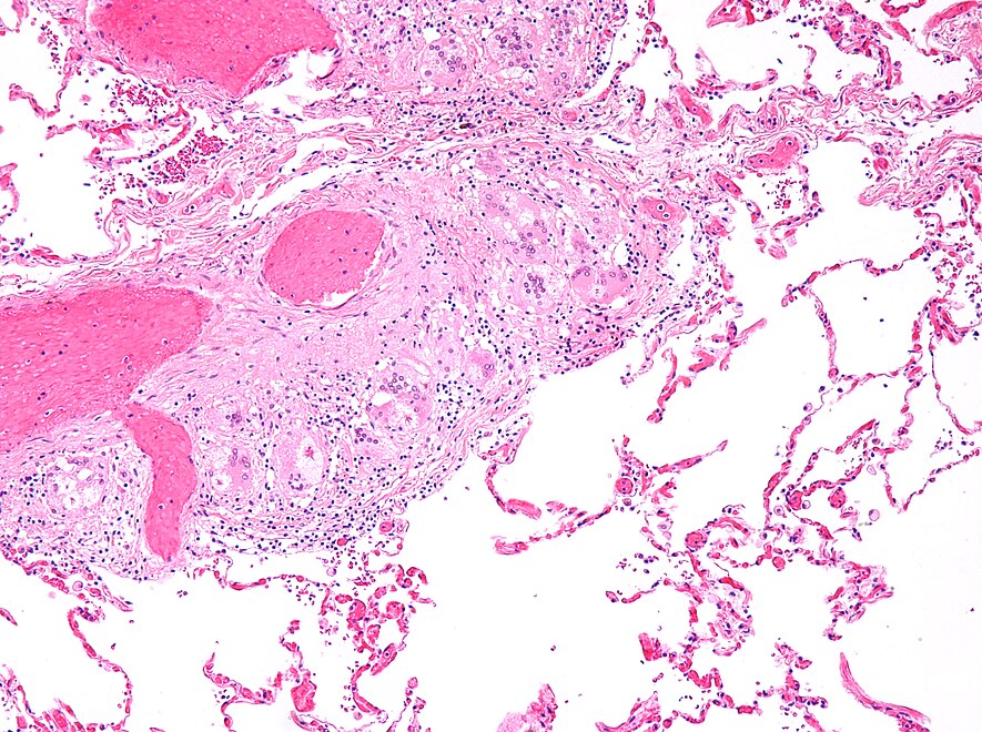 Pulmonary sarcoidosis with granulomas with Langhans giant cells and asteroid bodies