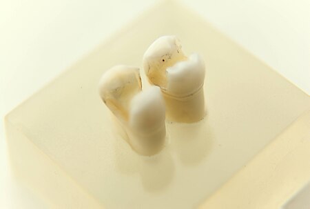 Fail:Dental inlays Gold Focus stacking with freeware CombineZP 12 09.jpg