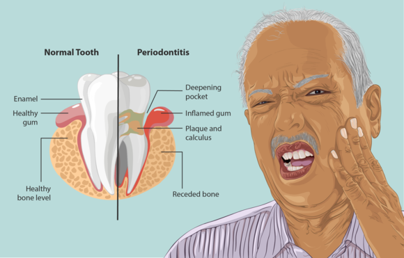 Person with periodontitis