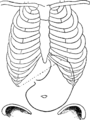Fig. 76. — Dislocation totale d'un estomac normal — Gonflement artificiel. — Le cardia est abaissé. — Vaste poche sous-pylorique due au mouvement de bascule de l'estomac en bas et plutôt à droite qu'à gauche (D'après Rosenheim).