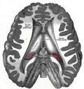 Thumbnail for Interthalamic adhesion