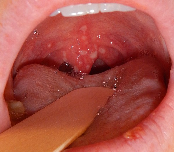 papilloma of lip icd 10)
