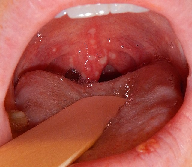 ulcer on tonsil