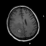 Hirnmetastase eines Bronchialkarzinoms in der Kernspintomographie (T1-Wichtung ohne Kontrastmittel)