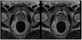 Standard reconstruction (left) versus reconstruction with DL (right) for a T2-weighted turbo spin-echo scan of the prostate Machine Learning.jpg