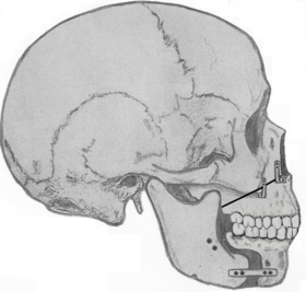 Maxillomadibular advancement.png