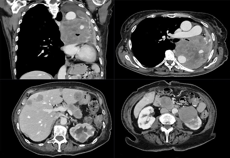File:Metastasiertes kleinzelliges Lungenkarzinom 67W - CT KM pv - 001.jpg