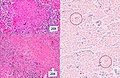 Microscopy of tuberculous micronodules.jpg