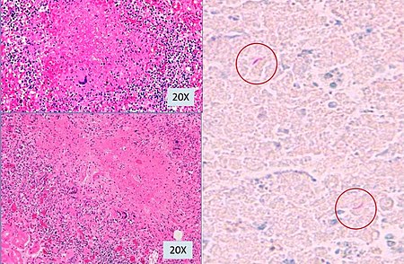 Microscopy of tuberculous micronodules.jpg