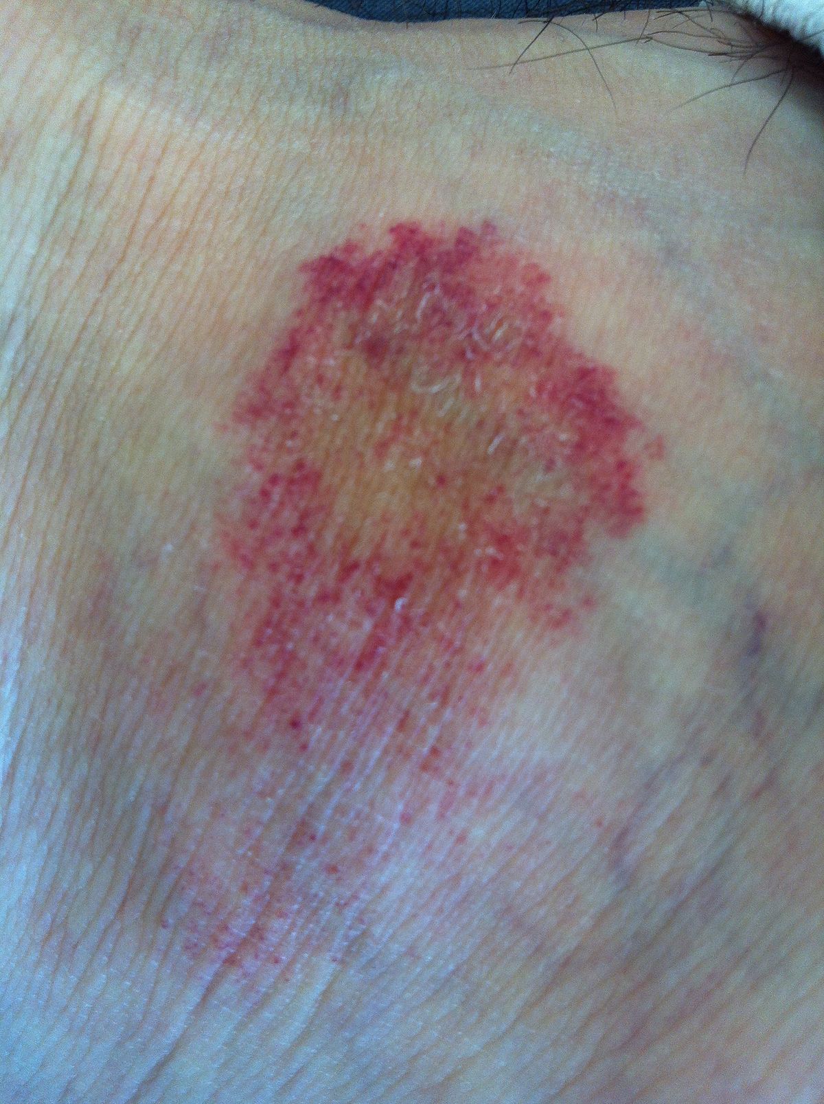 Pigmented Purpuric Dermatosis Wikipedia