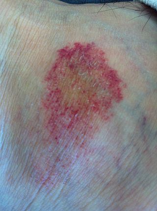 <span class="mw-page-title-main">Pigmented purpuric dermatosis</span> Medical condition