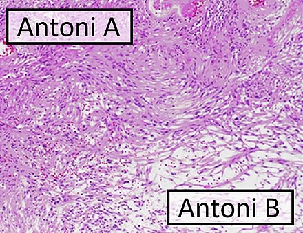 Micrograph of a schwannoma showing both a cellular Antoni A area (top) and a loose paucicellular Antoni B area (bottom). HE stain.