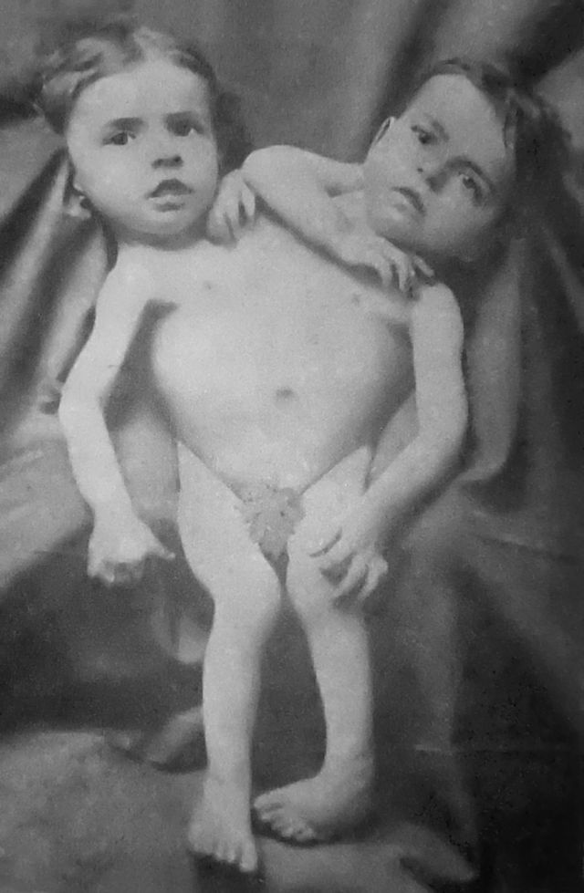 hensel twins anatomy