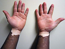 Nesegmentni vitiligo ba tamnoj šaci