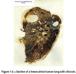Частина ліофілізованої легені людини, хворої на силікоз