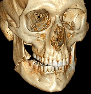 Mandibular fracture break through the mandibular bone