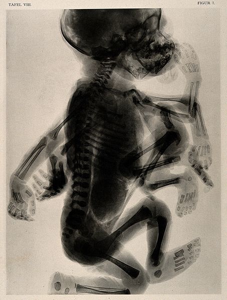 File:A skeleton of a child with a set of superfluous limbs and de Wellcome V0014963.jpg