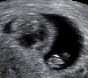إجهاض تلقائي: العلامات والأعراض, الأسباب, التشخيص