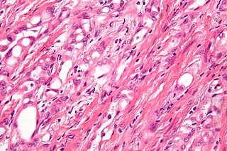 <span class="mw-page-title-main">Adenomatoid tumor</span> Medical condition