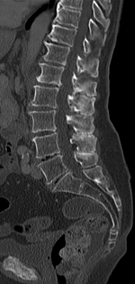 Sagittal CT of the lumbar spine showing Baastrup's sign. Baastrup CT sagittal.png