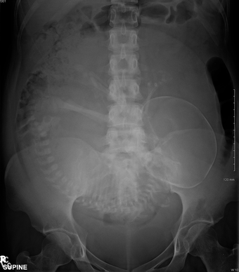 Abdominal radiograph of a pregnant woman, a procedure that should be performed only after proper assessment of benefit versus risk