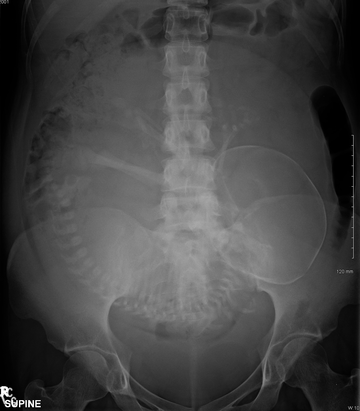 Abdominal radiograph of a pregnant woman, a procedure that should be performed only after proper assessment of benefit versus risk