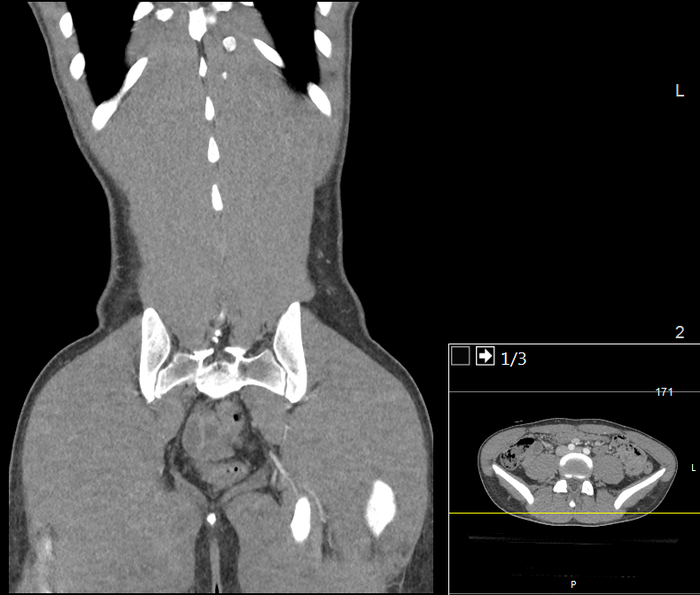 CT of a normal abdomen and pelvis, coronal plane 119.png
