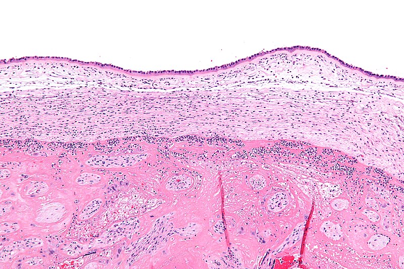 File:Chorioamnionitis - intermed mag.jpg