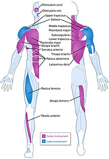 Facioscapulohumeral muscular dystrophy Medical condition