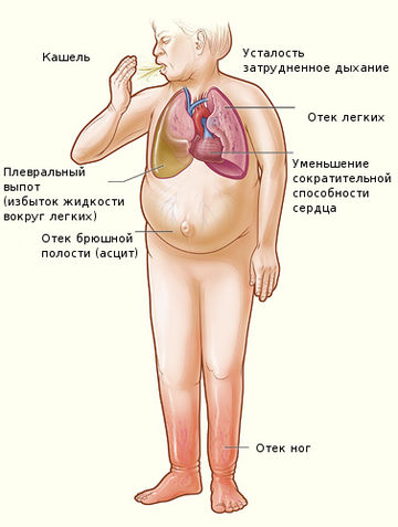 File:Heartfailure ru.jpg