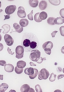 Hypogranular neutrophil with a pseudo-Pelger-Huet nucleus in MDS.jpg