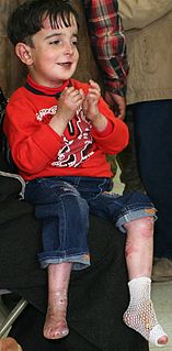 Epidermolysis bullosa Human disease