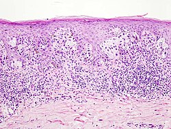 Histopathological picture of malignant melanoma, in this case suspected superficial malignant melanoma. Hematoxylin-eosin stained