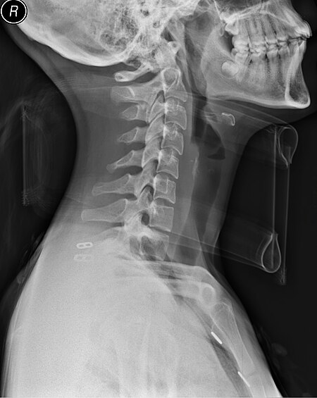 Medical X-Ray imaging RAH06 nevit.jpg
