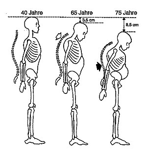 Osteoporose: Ursachen, Diagnostik, Krankheitsverlauf und Prognose