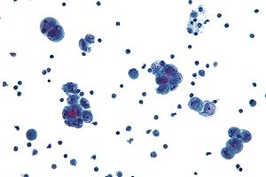 Seröz karsinom cytology.jpg