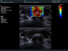 Fichier: Shear-Wave-élastographie-mai-Add-a-Nouvelle-Dimension à ultrasons-évaluation-de-thyroïde-nodosités Case-657147.f1.ogv