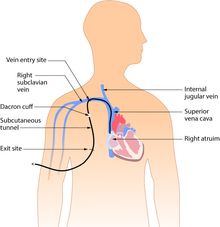 central venous catheter