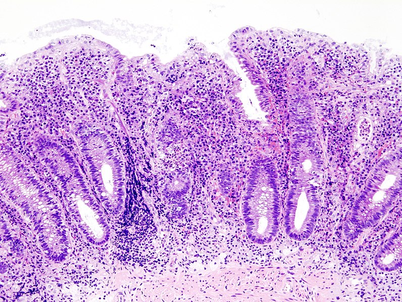 File:Ulcerative colitis (2) endoscopic biopsy.jpg