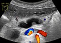 Ultrasonography of dilated pancreatic duct.jpg