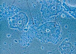 صورة مجهرية للبكتيريا المهبلية - الأنسجة الطلائية لعنق الرحم مغطاة ببكتيريا تشبه العصيات، Gardnerella vaginalis (أسهم).