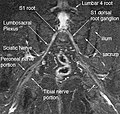 Thumbnail for Magnetic resonance neurography