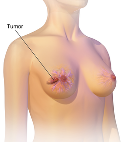 Breast cancer Cancer that originates in mammary glands