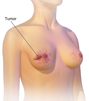 Como visto na imagem acima, a mama já está afetada pelo câncer