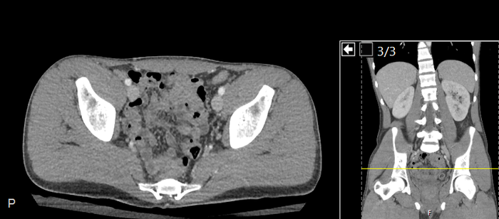 CT of a normal abdomen and pelvis, axial plane 229.png