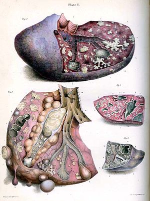 Carswell-Tubercle.jpg